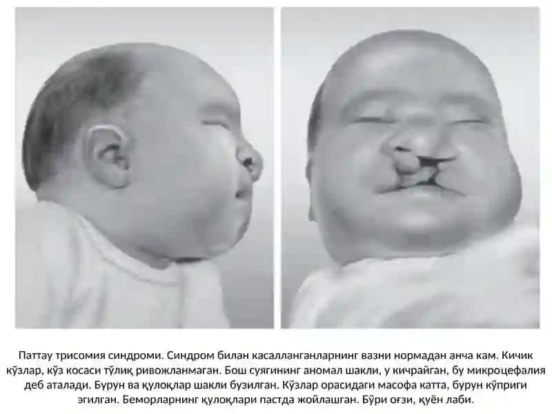 CHAQALOQLAR VA BOLALAR KASALLIGI 3