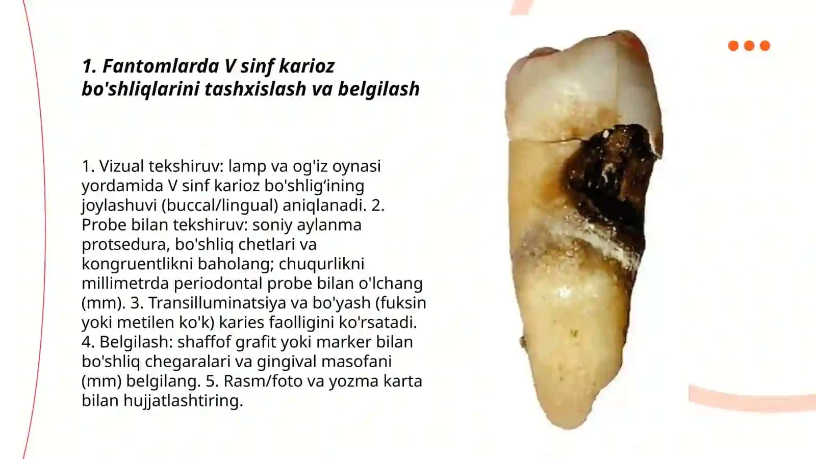 Fantomlarda V sinf karioz bo'shliqlarini charxlash va plombalash 3