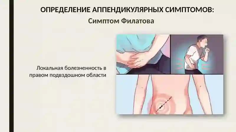 Ректальное исследование при тазовом аппендиците 3