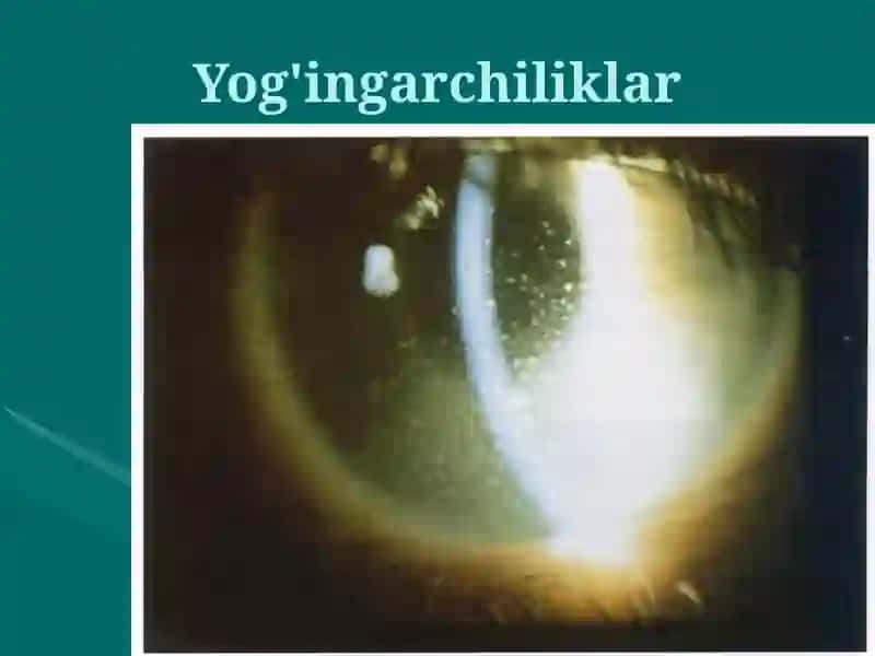 Ko'z kasalliklari 3