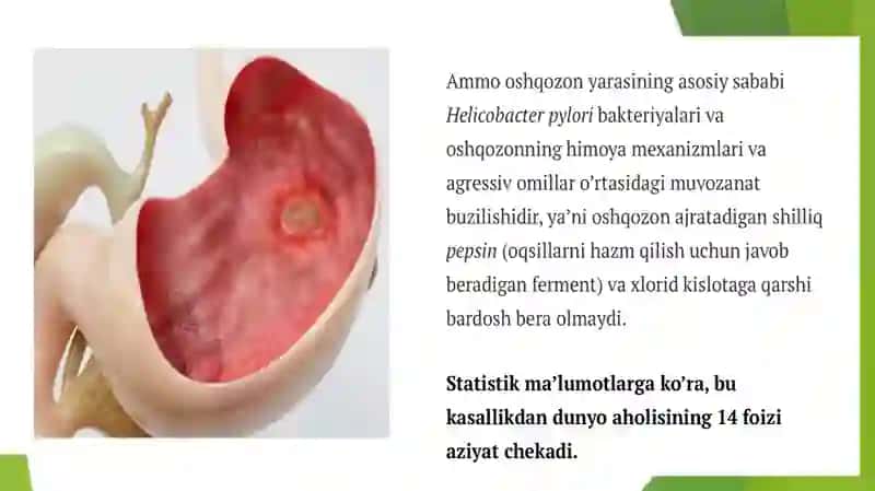 Oshqozon yara va 12 barmoq ichak yarasi 3
