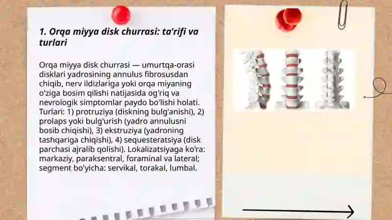 Orqa miyya disk churrasi 3
