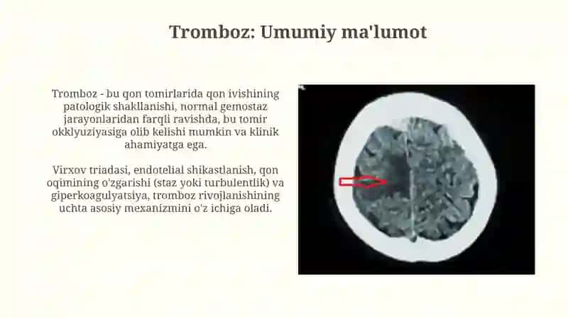 Tromboz 3