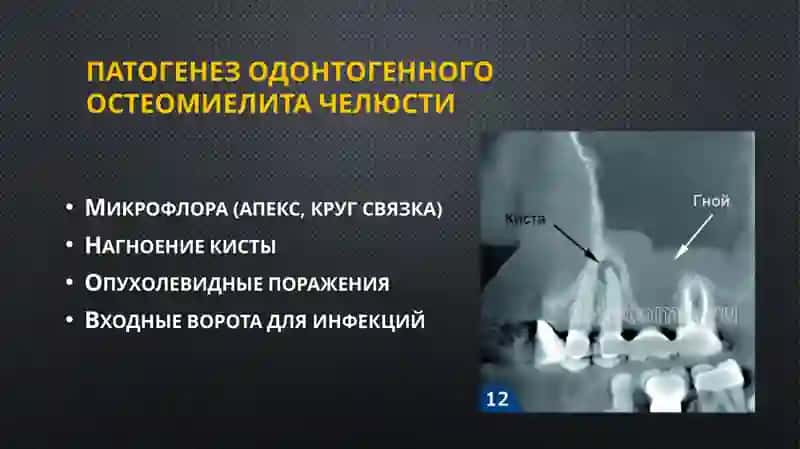 Одонтогенный остеомиелит челюсти 3