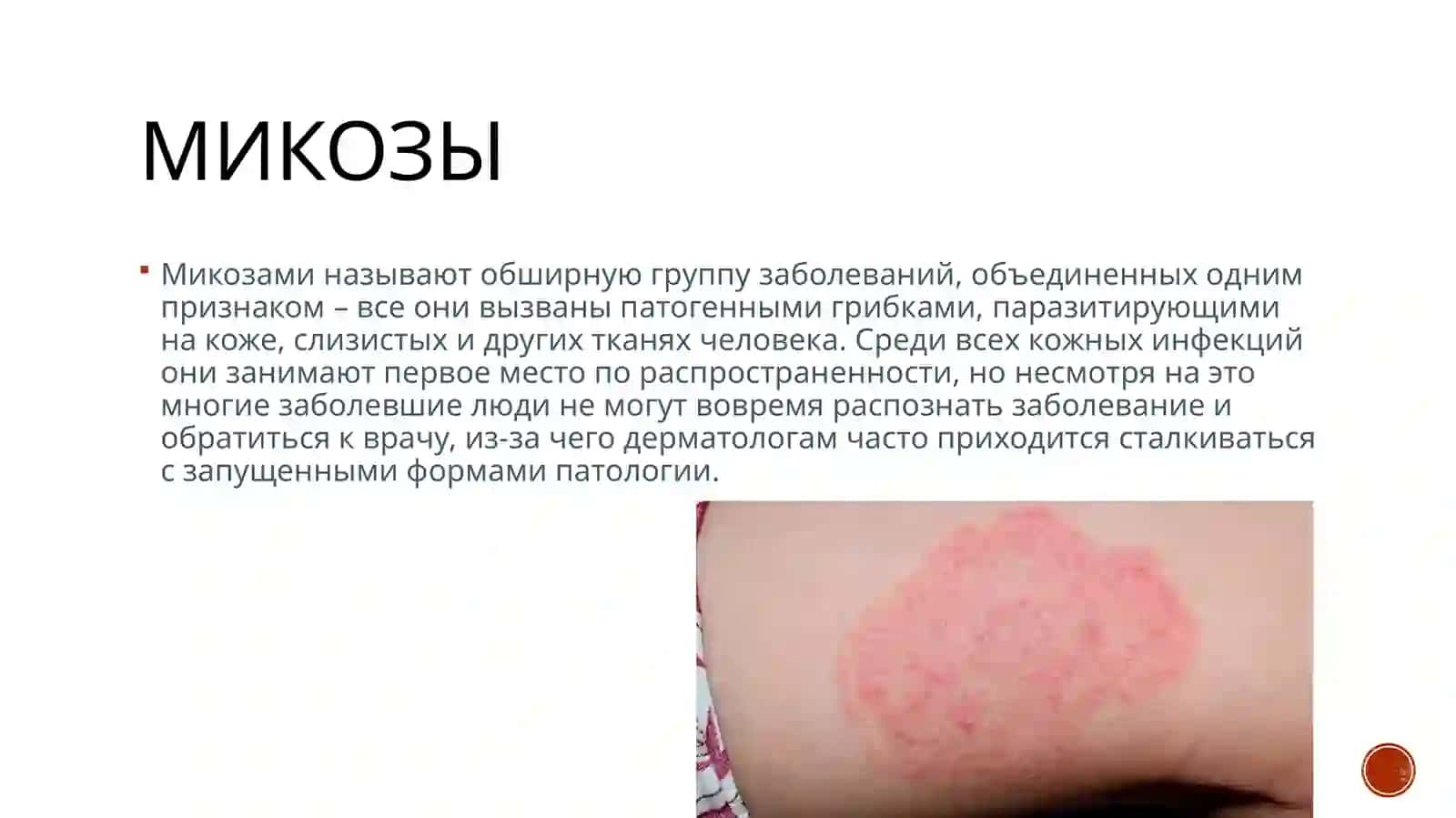 микозы 3