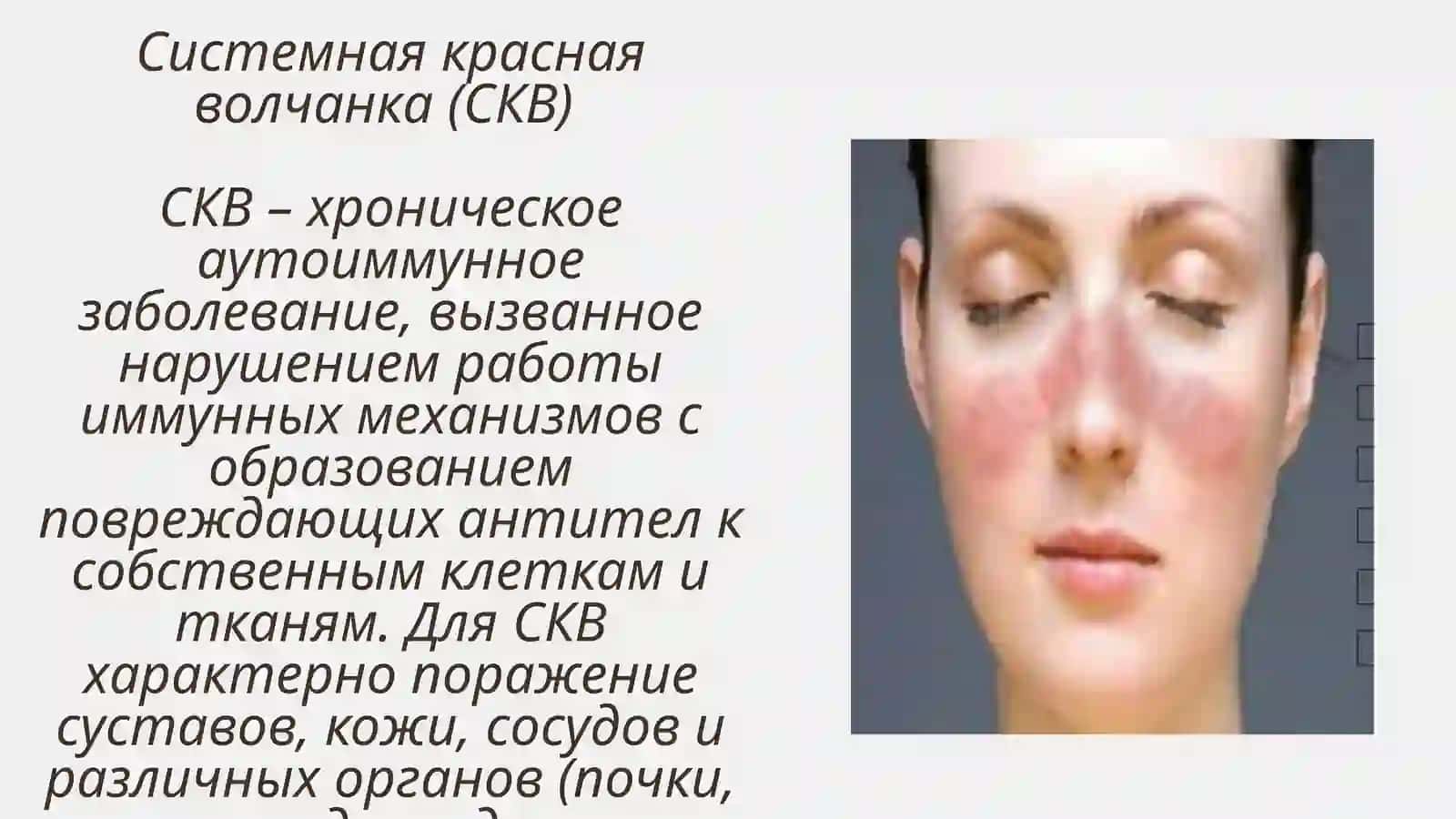 ОБСЛЕДОВАНИЕ БОЛЬНЫХ С КОЛЛАГЕНОЗАМИ 3