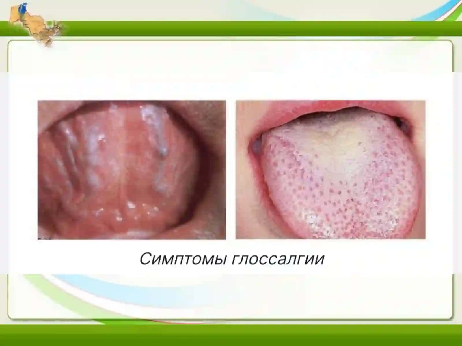 Glossalgiya tashxislash klinikasi.Davolash metodikasi. 3
