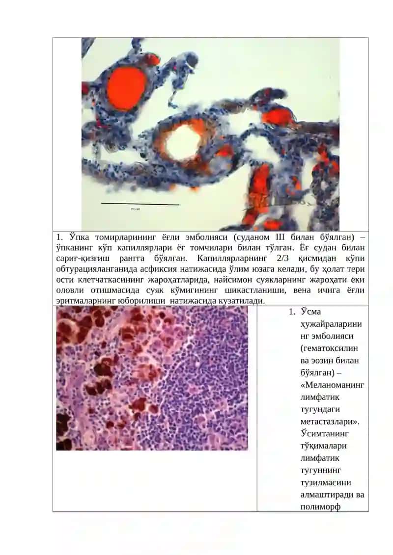 Тромбоз, Эмболия ва Инфаркт 3