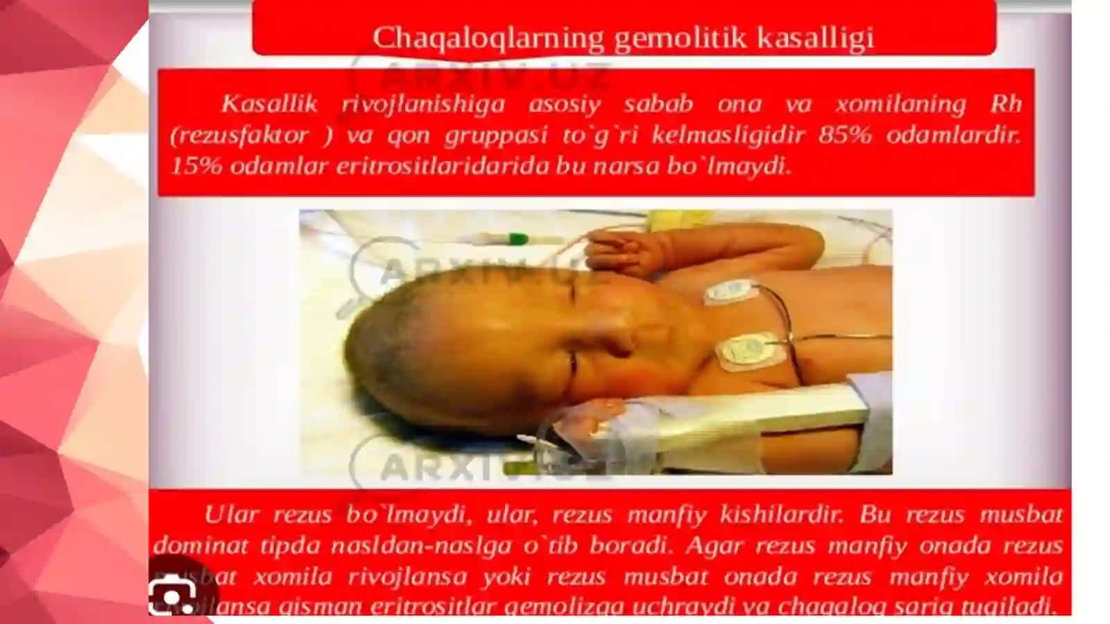 Chaqaloqlar gemolitik kasalligi 3