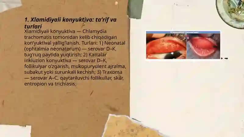 Xlamidiyali konyuktivalar 3