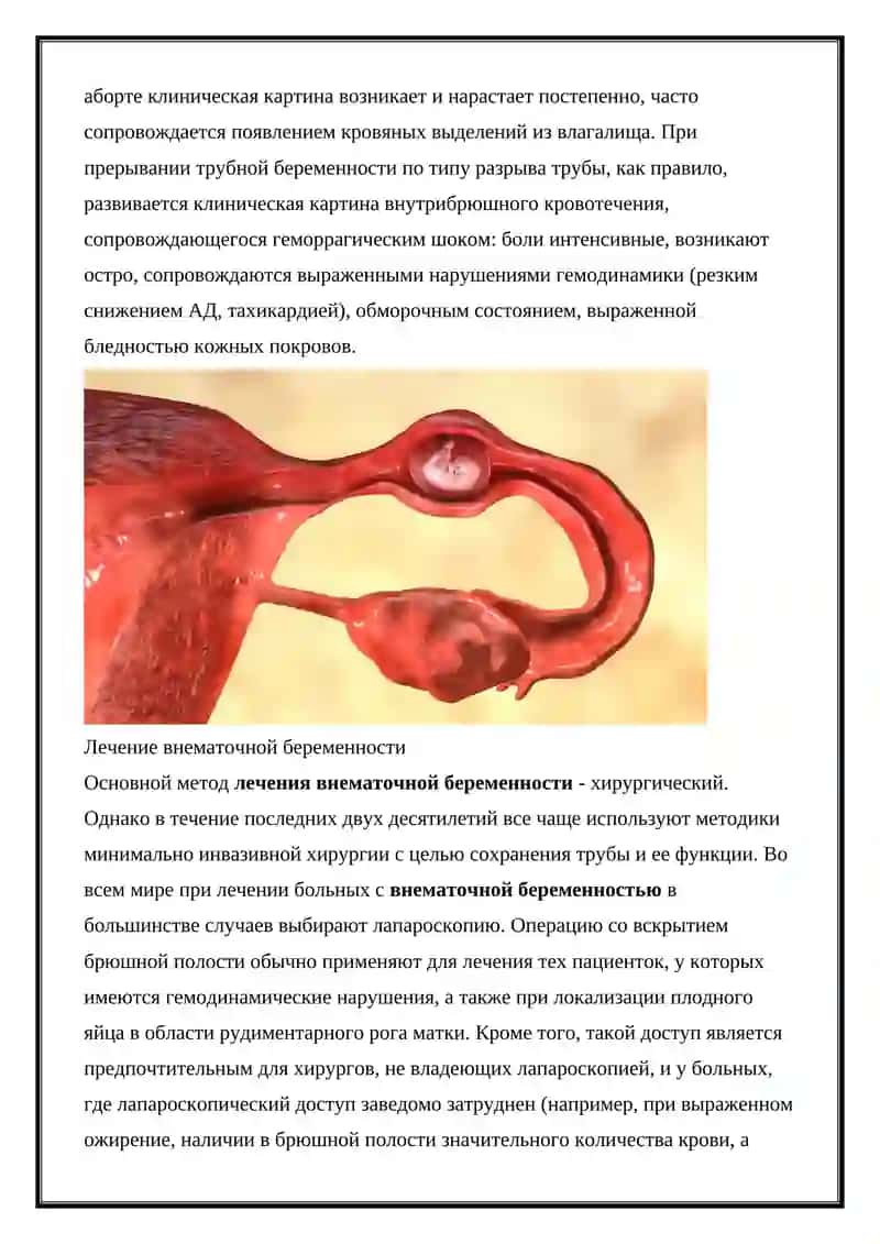 Внематочная беременность 3