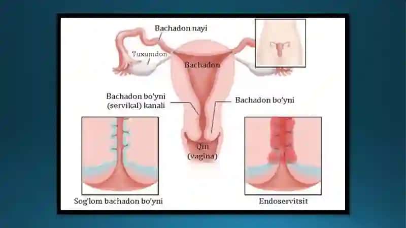 ENDOSERVITSIT 3