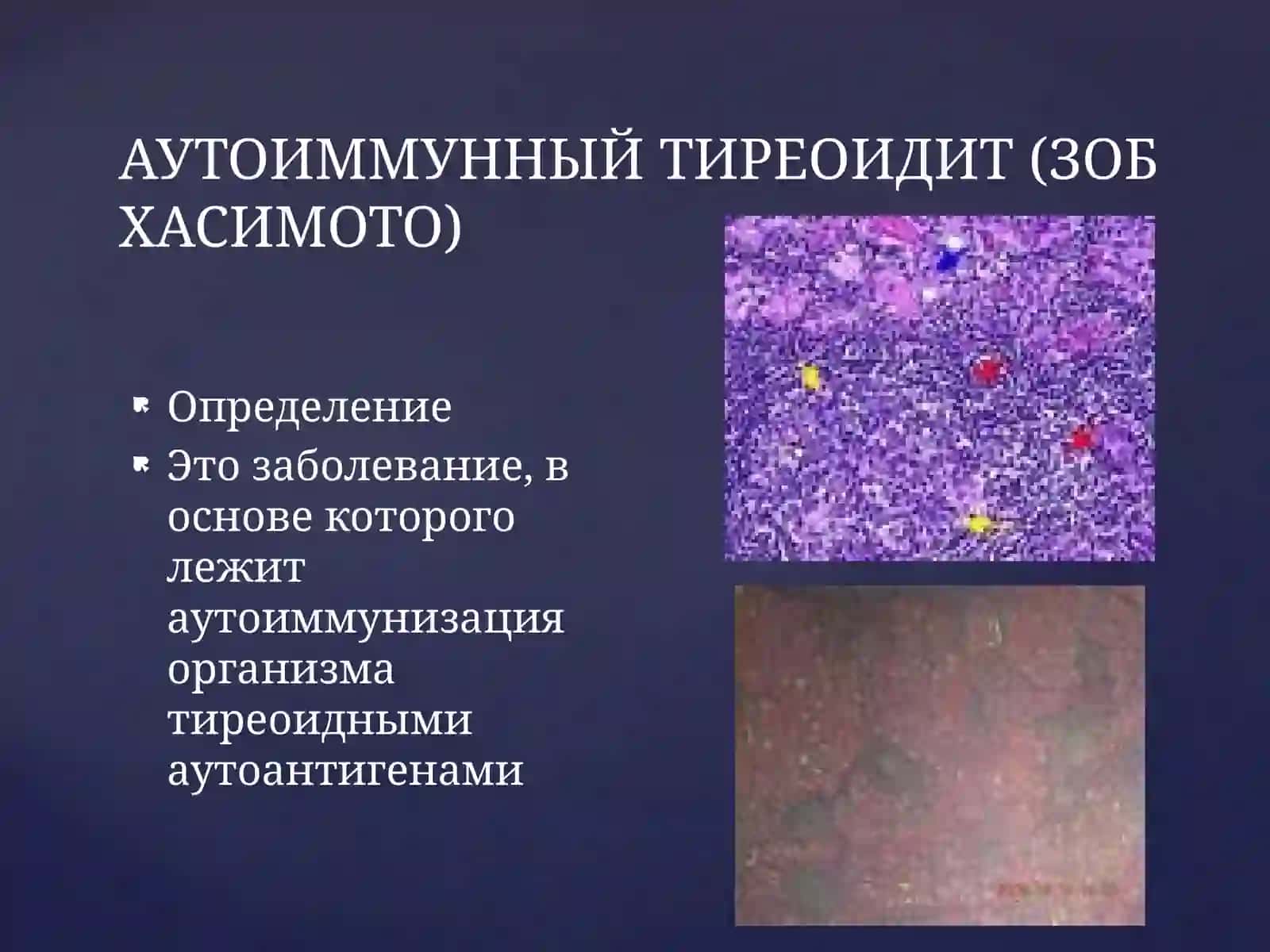 Тиреоидиты, 7-практическое занятие 3