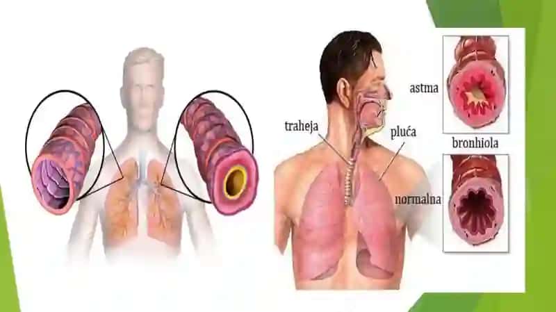 BRONXIAL ASTMA tasnifi, etiologiyasi, patogenezi va davolash 3