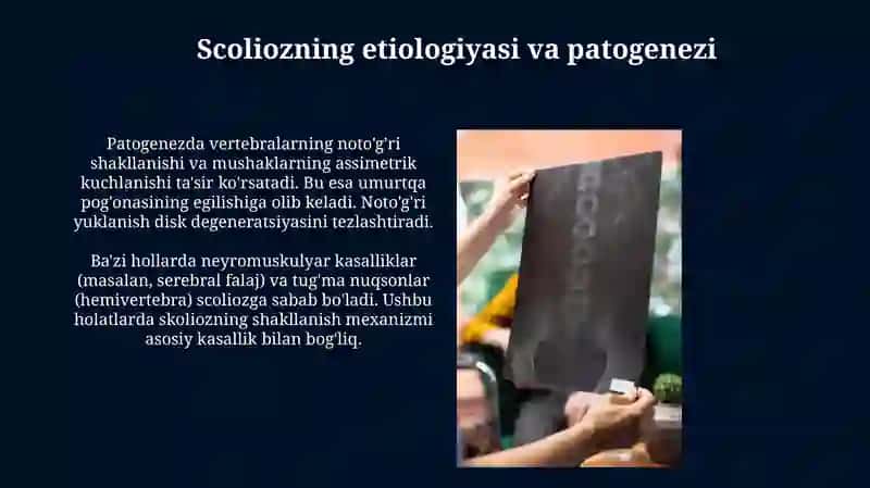 Osteoxondropatiyalar.Skolioz 3