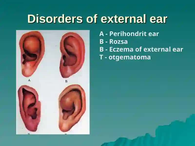 Acute and chronic inflammatory diseases of the ear 3