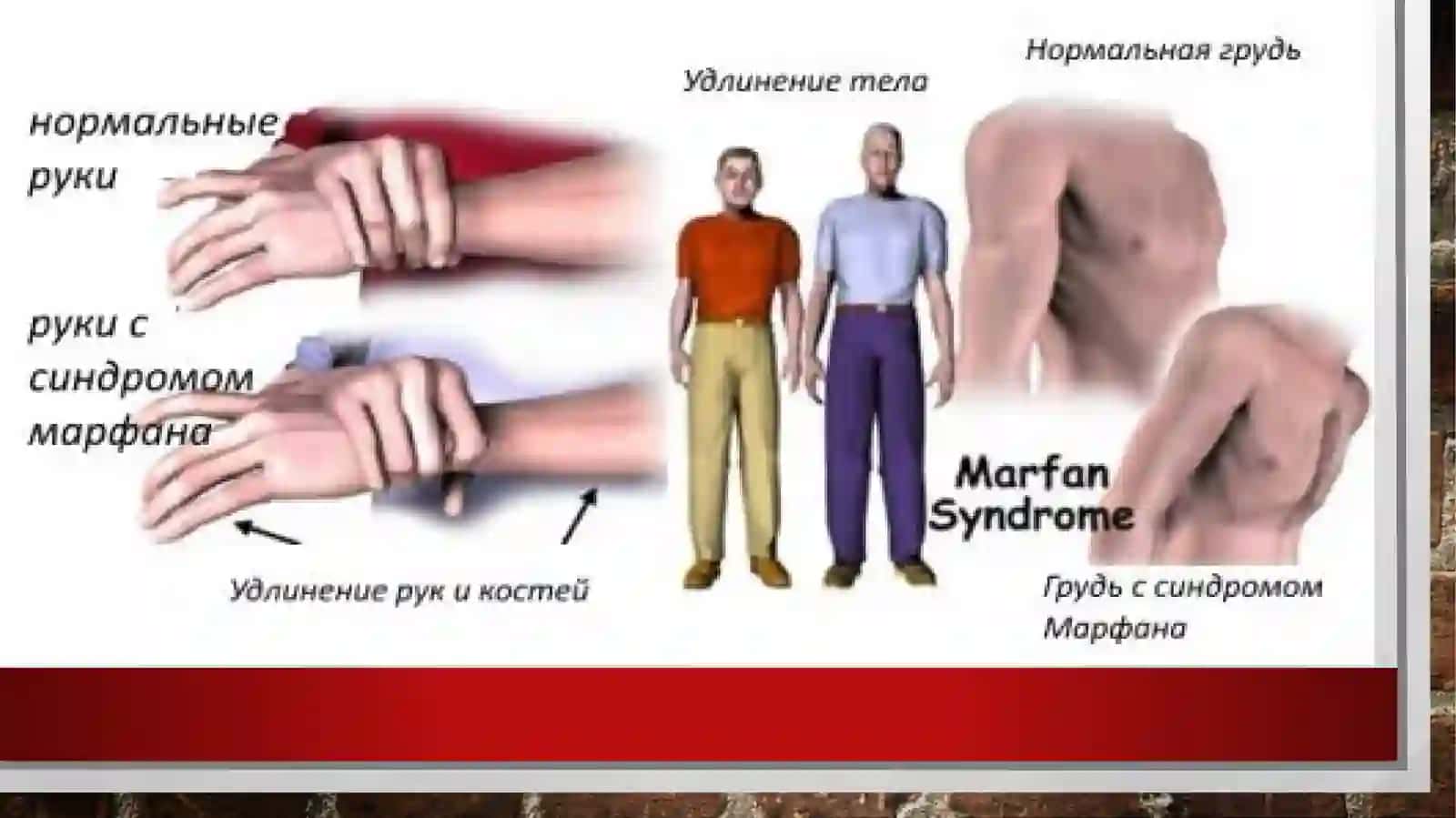MARFAN SINDROMI 3