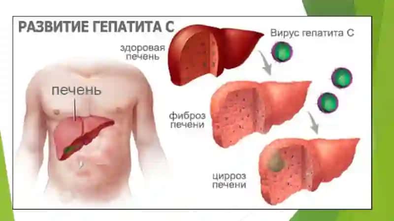 Virusli gepatit C etiologiyasi, patogenezi va davolash 3
