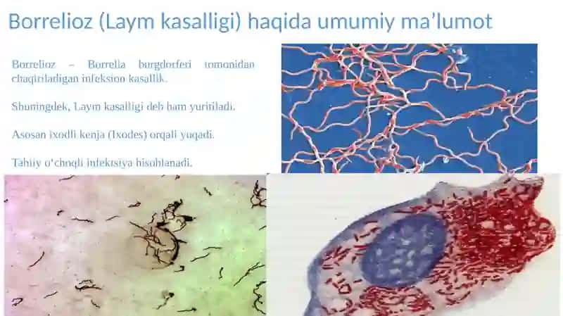 Borrelioz (Laym kasalligi) 3