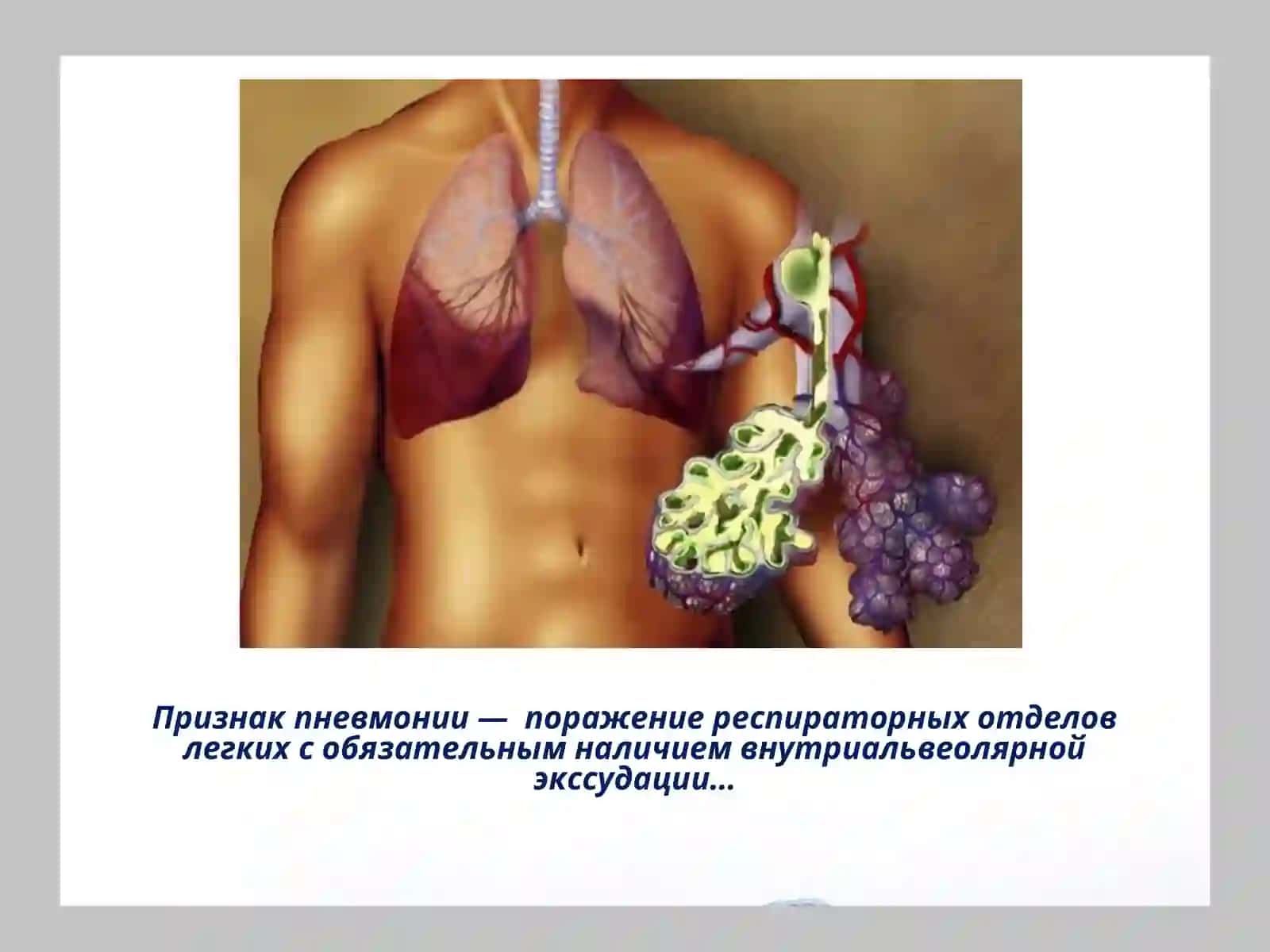 ПНЕВМОНИЯ 3
