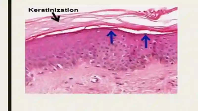 Keratinizatsiya jarayonlari haqida 3