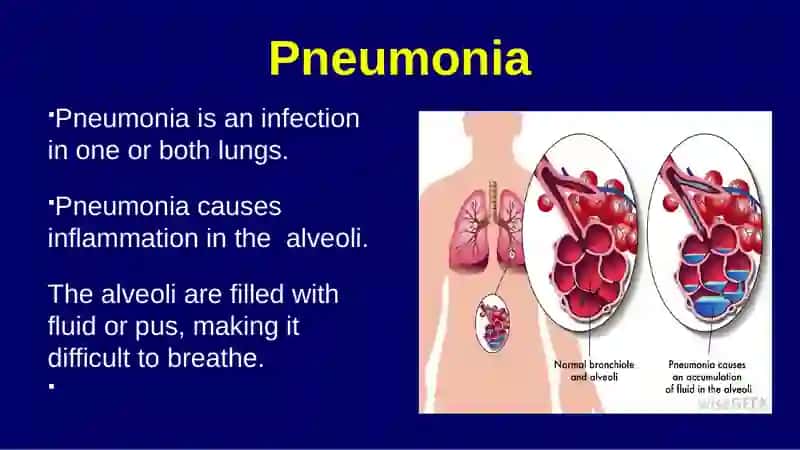 Pneumonia 3