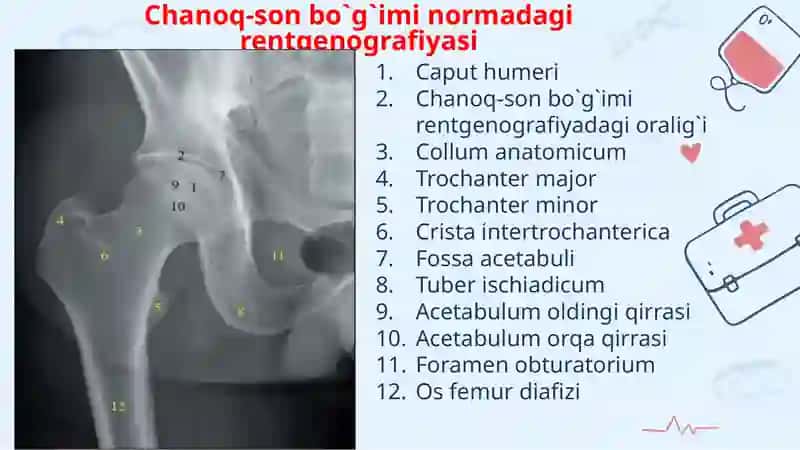 Son suyagi proksimal qismi sinishlari 3