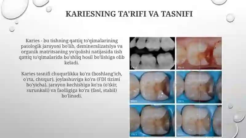 Kariesning ta'rifi va tasnifi 3