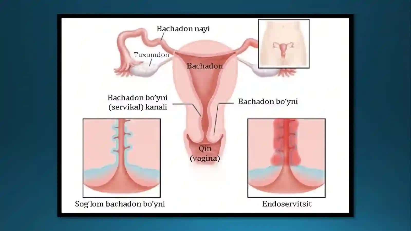 ENDOSERVITSIT — SABABLARI,ALOMATLARI,TASHXISLASH,DAVOLASH,ASORATLARI,OLDINI OLISH 3