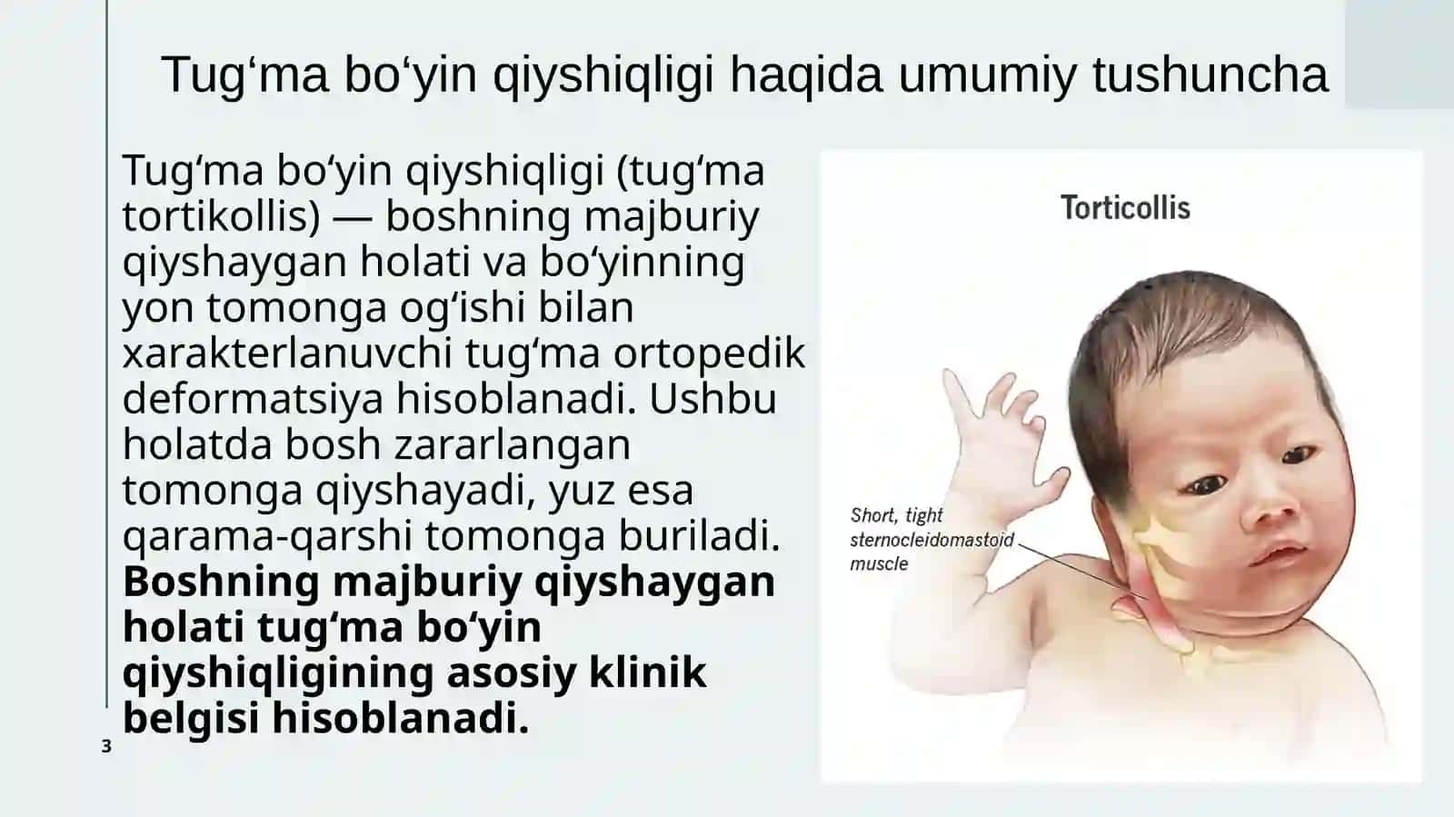 Tug‘ma bo‘yin qiyshiqligi (tug‘ma tortikollis) 3