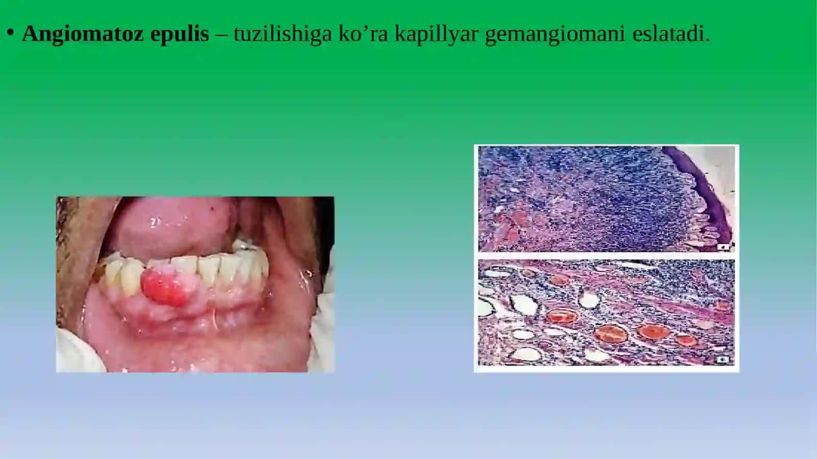 EPULIS (MILK USTI XOSILASI) 3