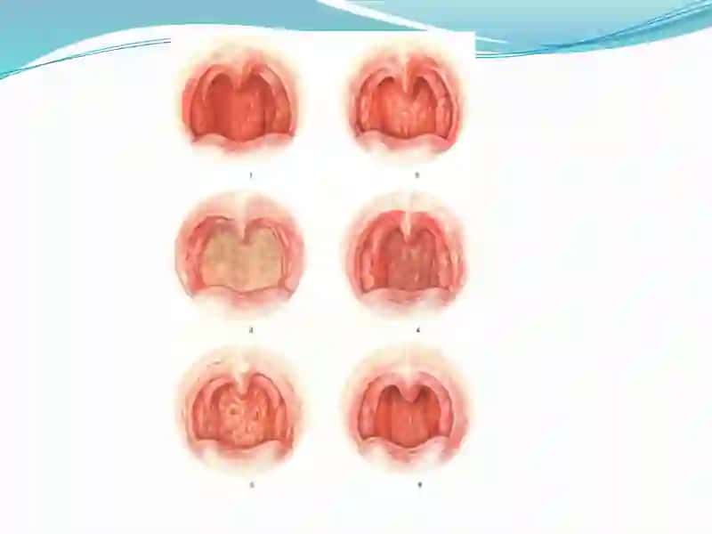 SURUNKALI FARINGIT(pharyngitischronica) 3