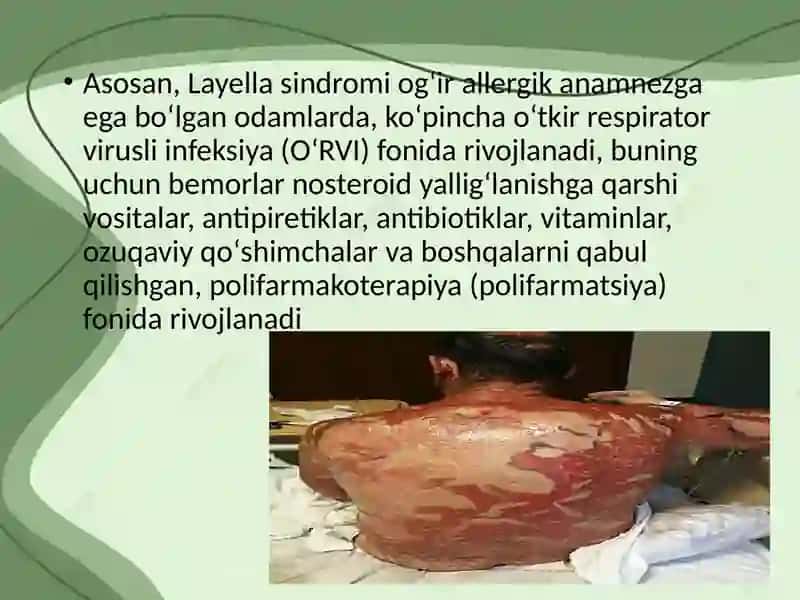 Layell va Stiven Djonson sindromlari 3
