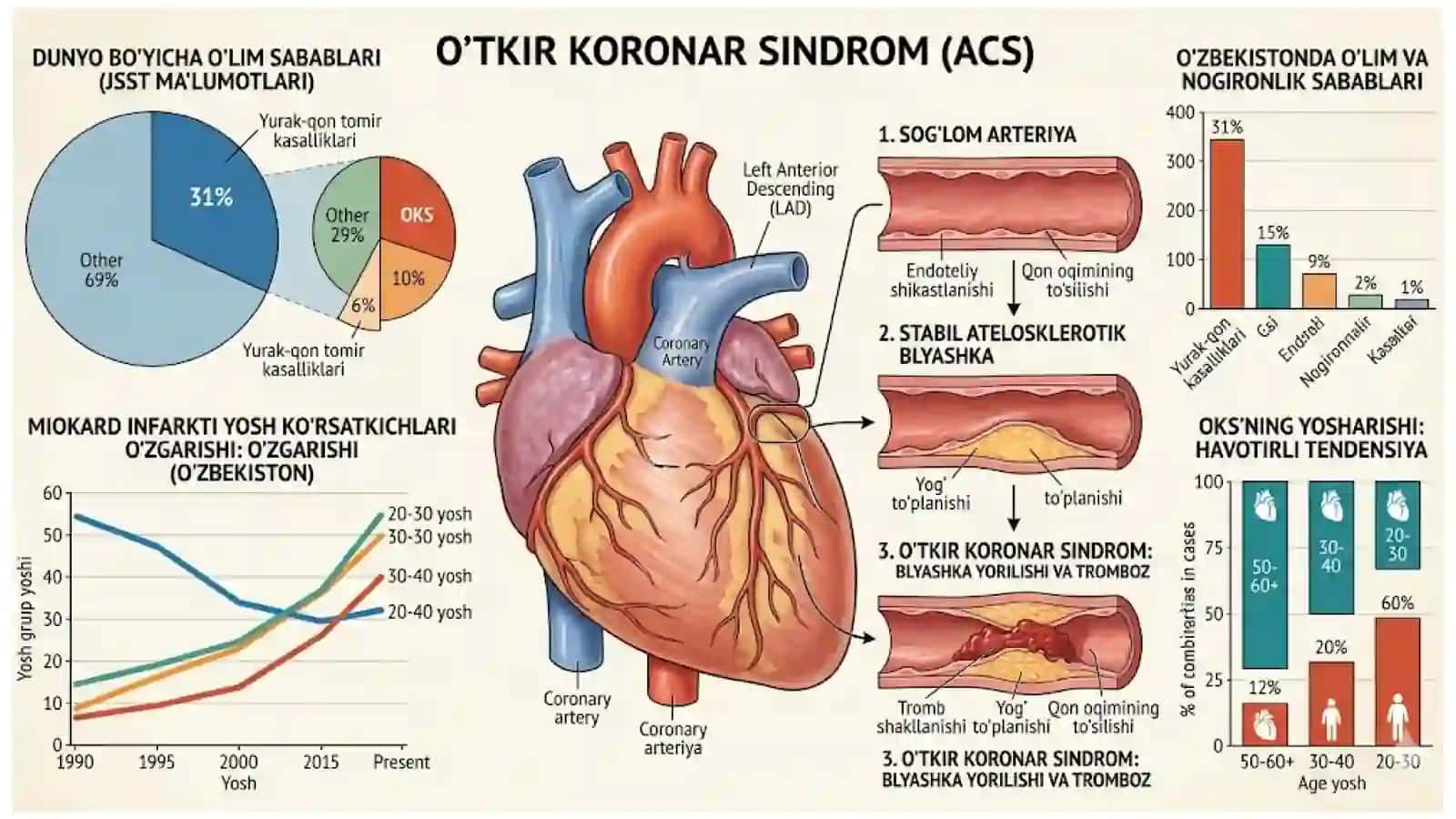O‘TKIR KORONAR SINDROM 3