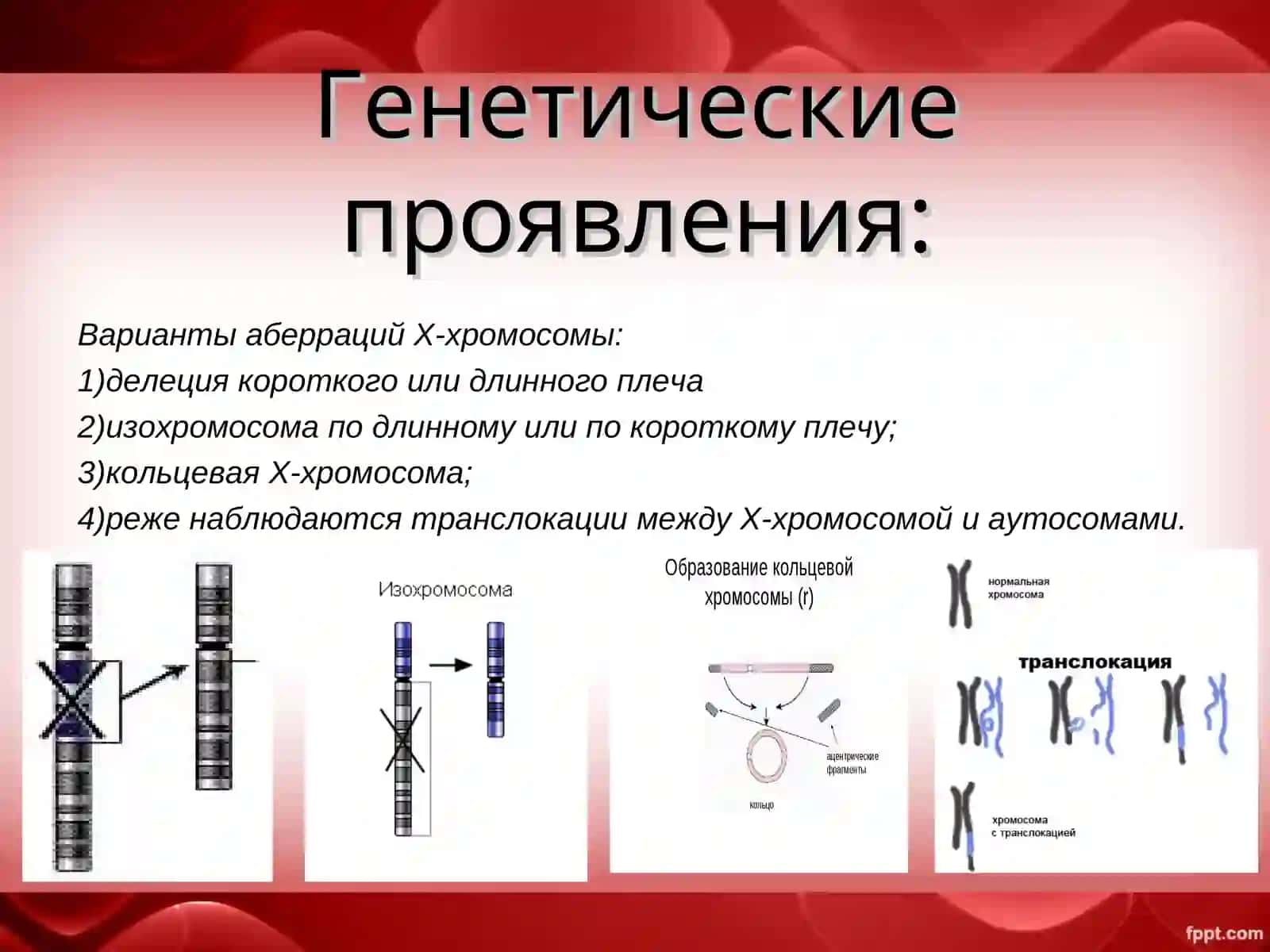 Синдром Шерешевского-Тернера 3