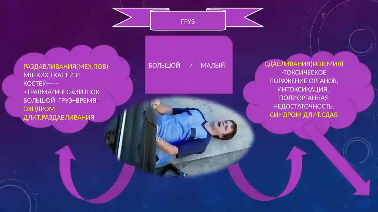 Синдром длительного сдавления (СДС) 3
