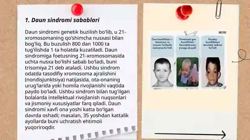 Daun sindromi haqida ma'lumot 3