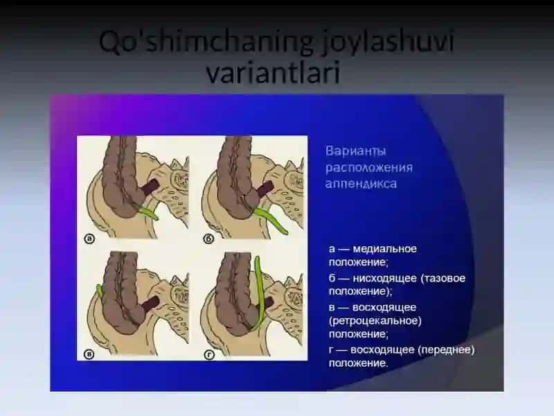 Oʻtkir appenditsita tipik kechishi 3