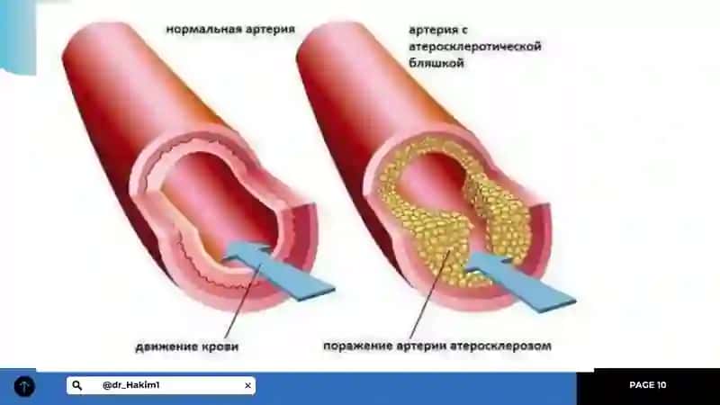 Arterial Gipotenziya:Bosimning Pasayishi 3