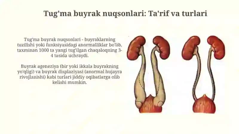 Tug'ma buyrak nuqsonlari 3