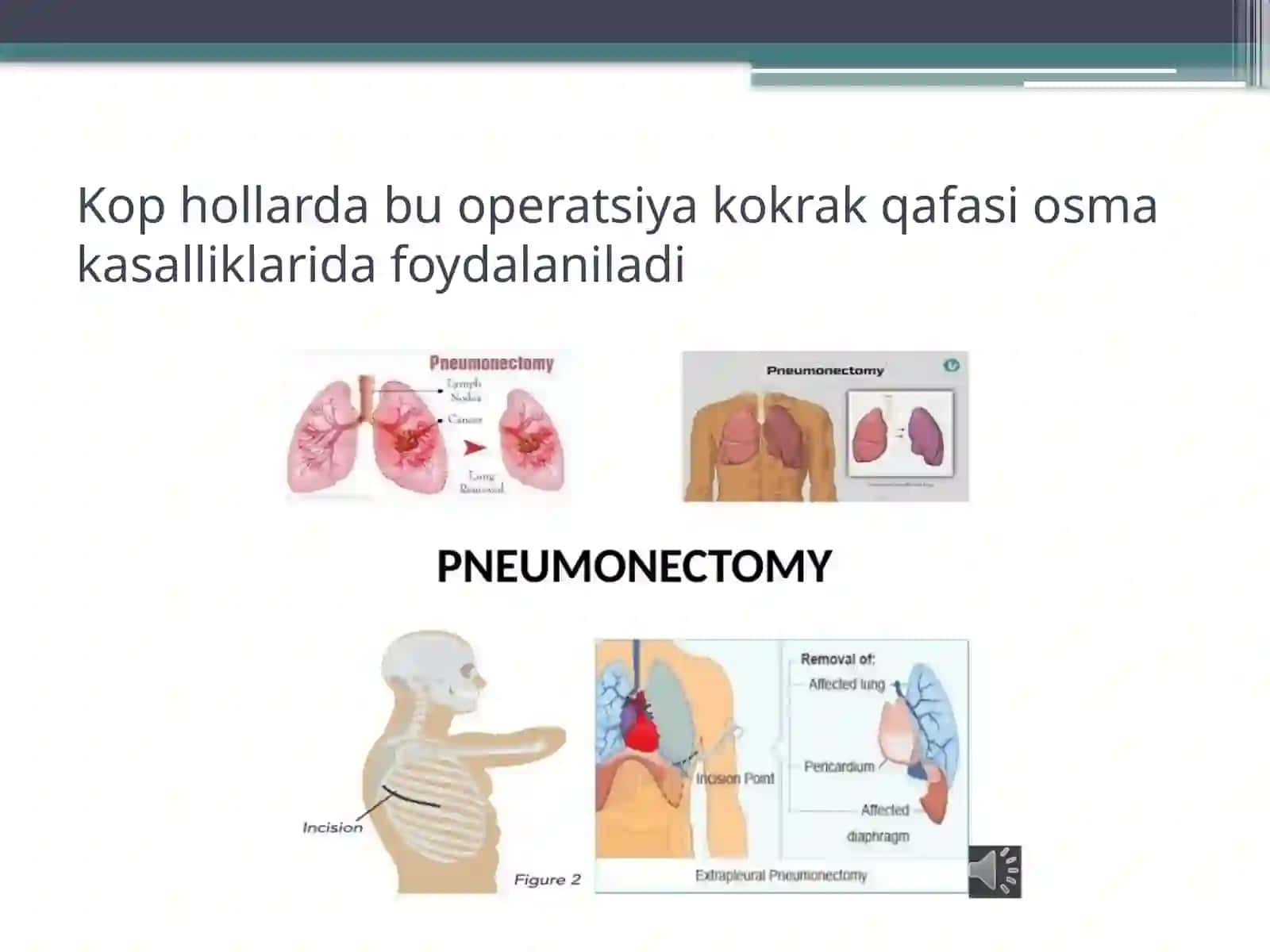 Pnevmoektomiya 3