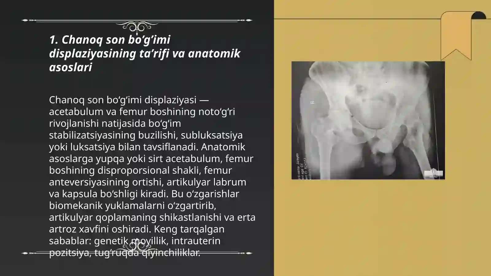 Chanoq son bo’g’imi displaziyasi 3