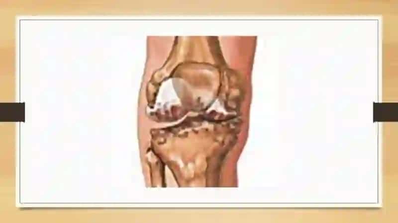 Osteoxondropatiyasi 3