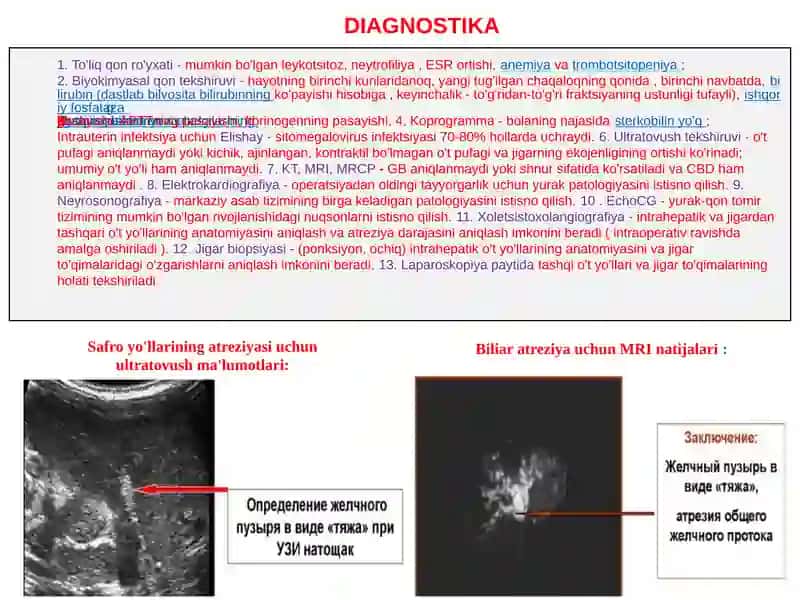 Xoletsistopatiya 3