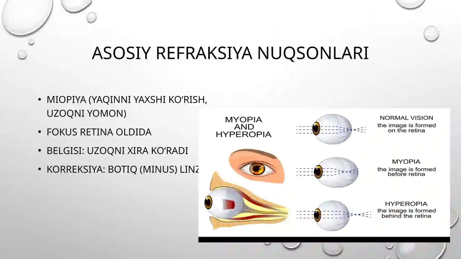 Ko’rishni optik korreksiyasi. Optik ko’zoynak turlari 3