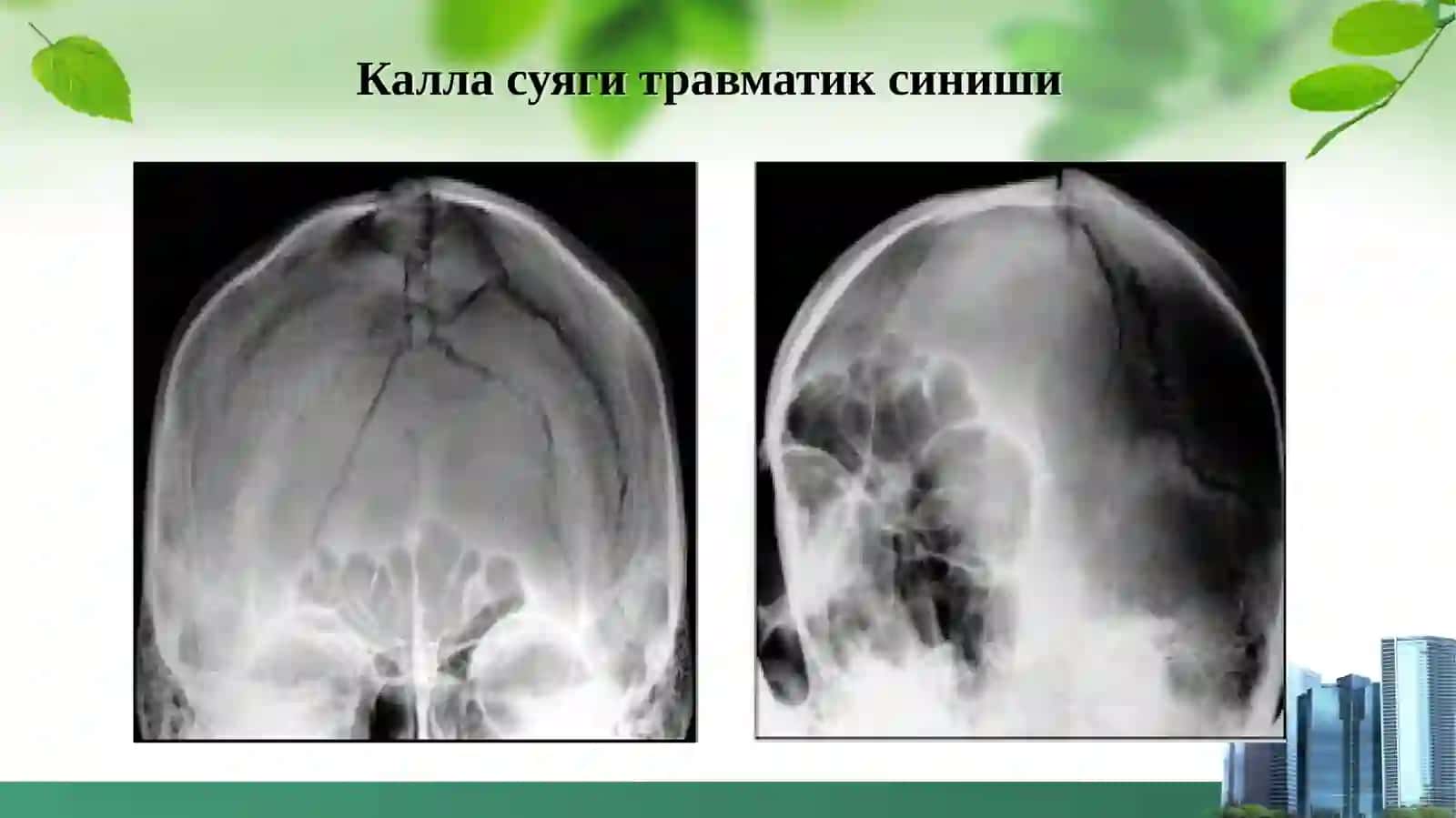 НЕЙРОХИРУРГИК ТЕКШИРИШ МЕТОДЛАРИ 3