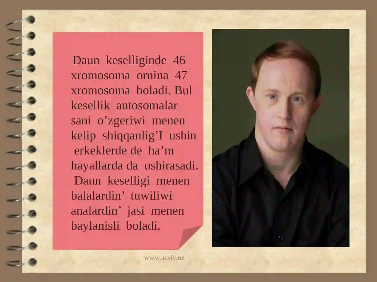 Xromosoma kesellikleri, Daun sindromi 3