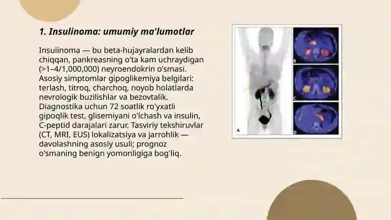 Insulinoma 3