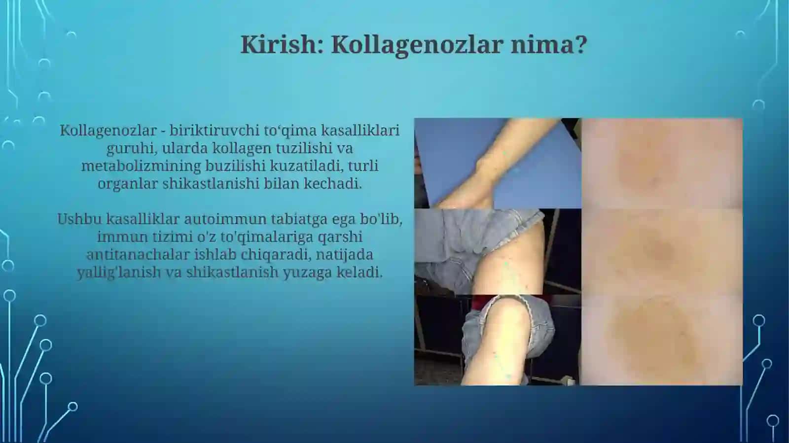 Kollagenozlar, patogenezivatashxisi 3