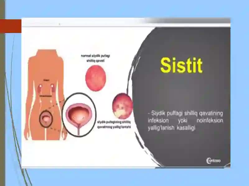 Bolalardagi siydikyo‘llari infeksiyalari 3